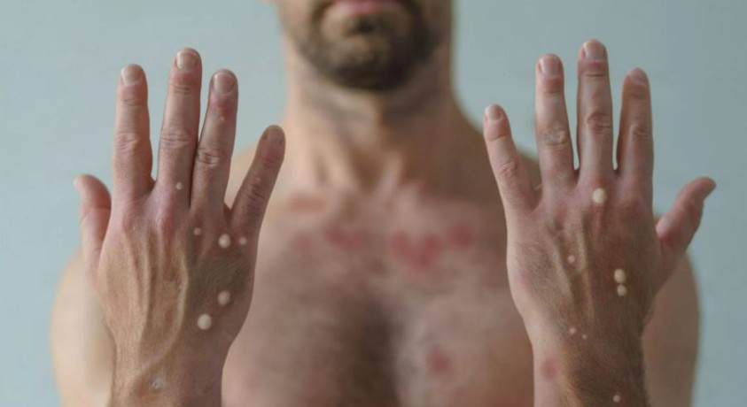 “მაიმუნის ყვავილის” ვირუსი და საქართველო