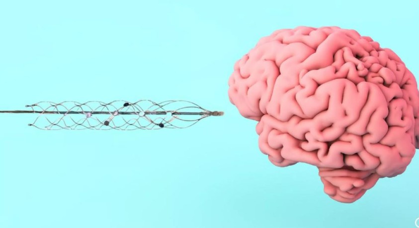 Neuralink-ის მიკროჩიპი ადამიანის ტვინში პირველად ჩანერგეს